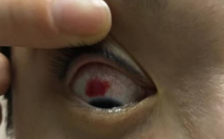 戴美瞳后眼睛充血怎么办，戴美瞳后眼睛模糊怎么办