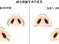 鼻子宽适合什么眼镜，鼻子宽怎么改善
