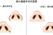 鼻子宽适合什么眼镜，鼻子宽怎么改善