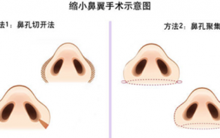 鼻子宽适合什么眼镜，鼻子宽怎么改善
