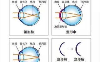 近视和散光怎么办，近视和散光一起怎么配眼镜