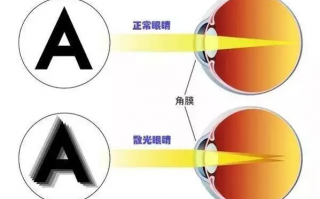 眼镜散光是怎么造成的，眼镜散光是怎么造成的呢